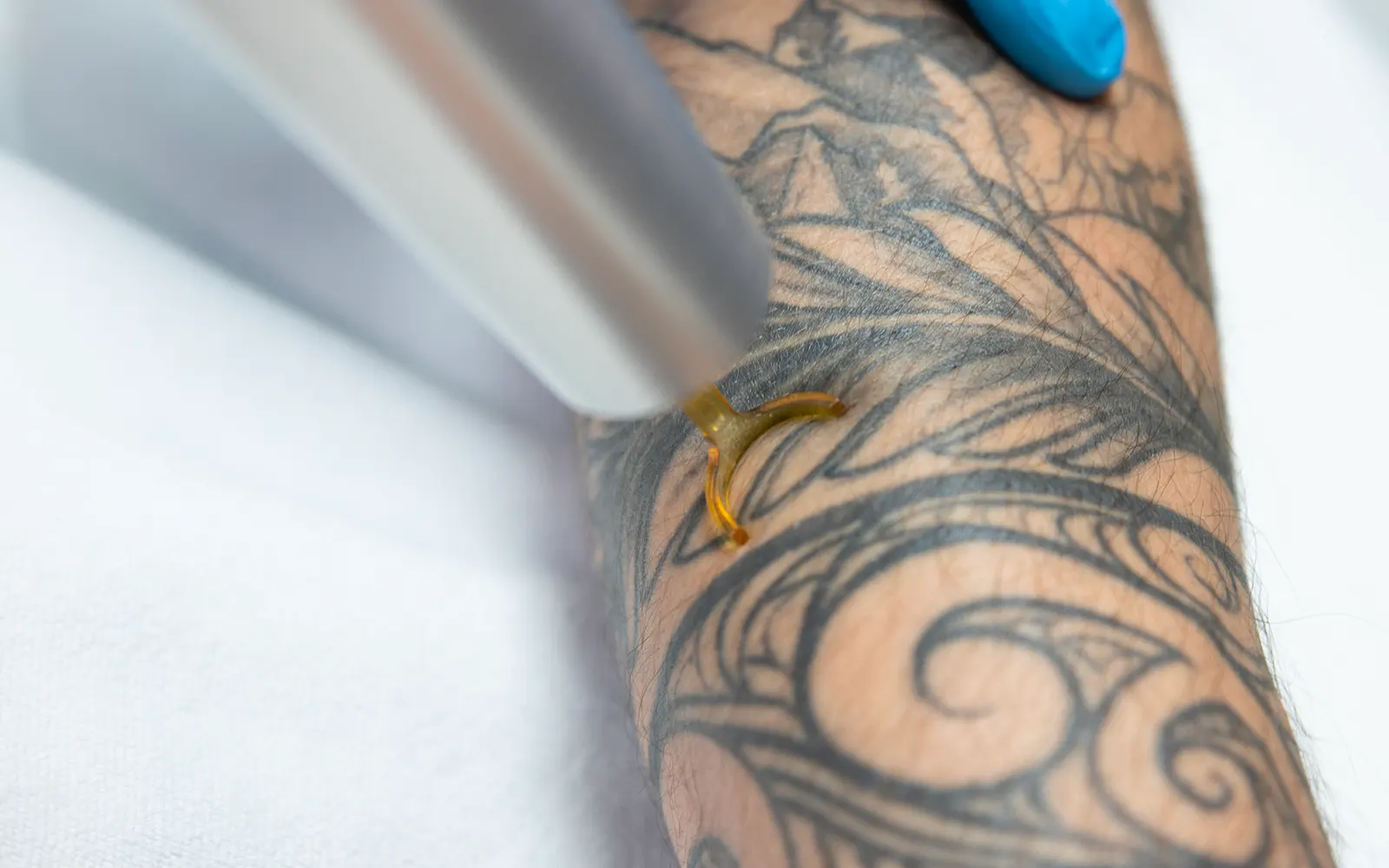 Traitement de détatouage au laser