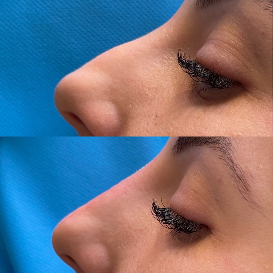 Résultat avant et après une rhinoplastie médicale par acide hyaluronique, cas 1