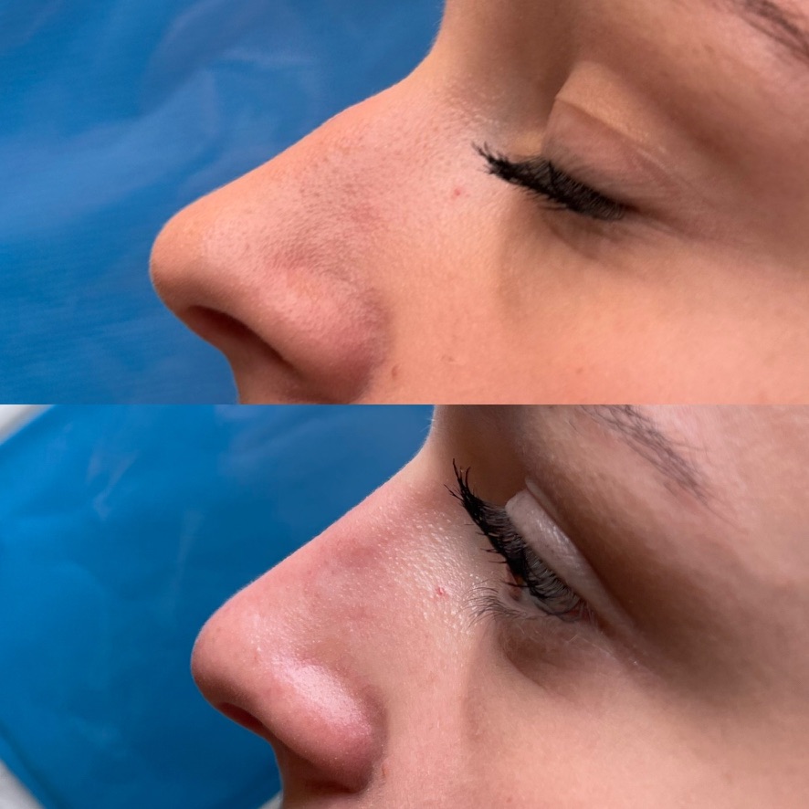 Résultat avant et après une rhinoplastie médicale par acide hyaluronique, cas 2