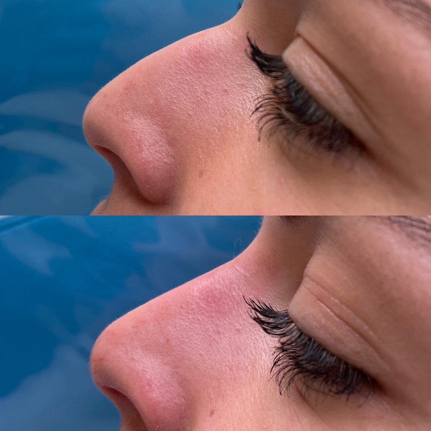 Résultat avant et après une rhinoplastie médicale par acide hyaluronique, cas 3