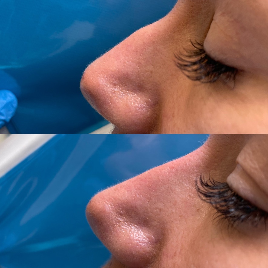 Résultat avant et après une rhinoplastie médicale par acide hyaluronique, cas 4