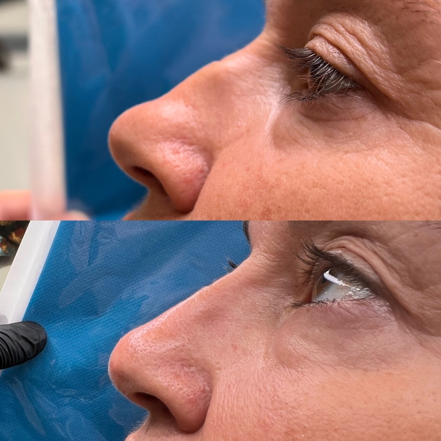 Résultat avant et après une rhinoplastie médicale par acide hyaluronique, cas 5