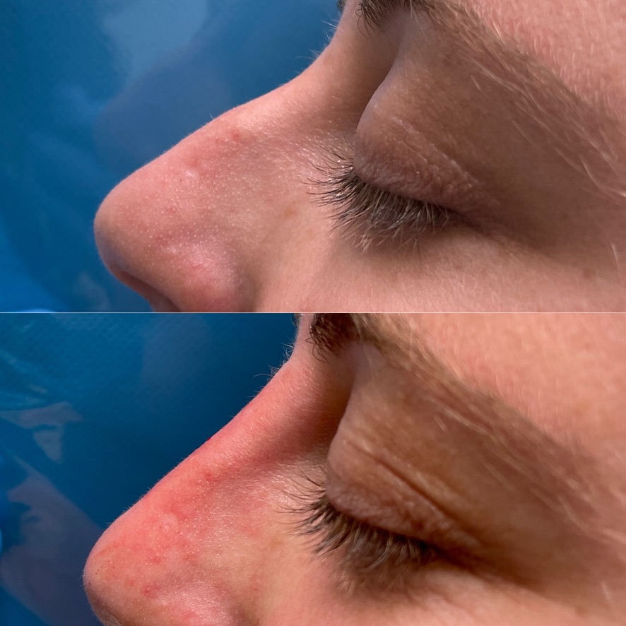 Résultat avant et après une rhinoplastie médicale par acide hyaluronique, cas 6