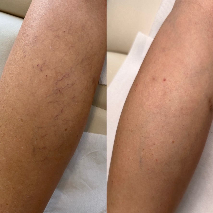 Résultat avant et après un traitement laser de varicosités des membres inférieurs, cas 1