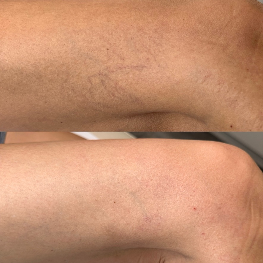 Résultat avant et après un traitement laser de varicosités des membres inférieurs, cas 2