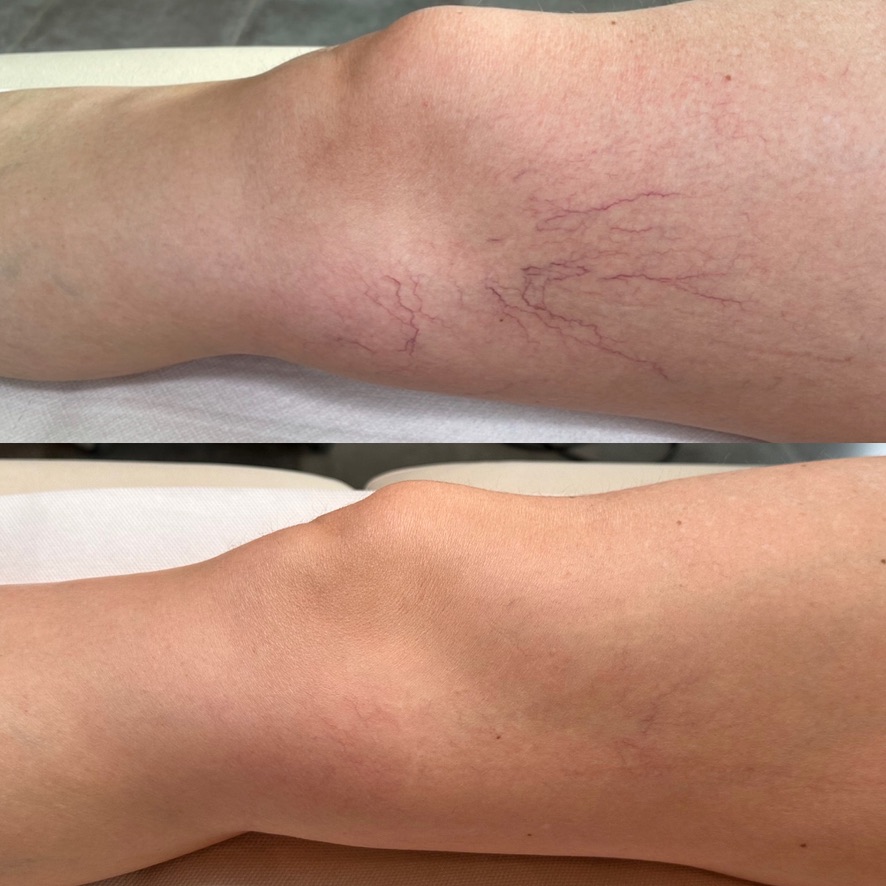 Avant et après un traitement laser vasculaire des jambes